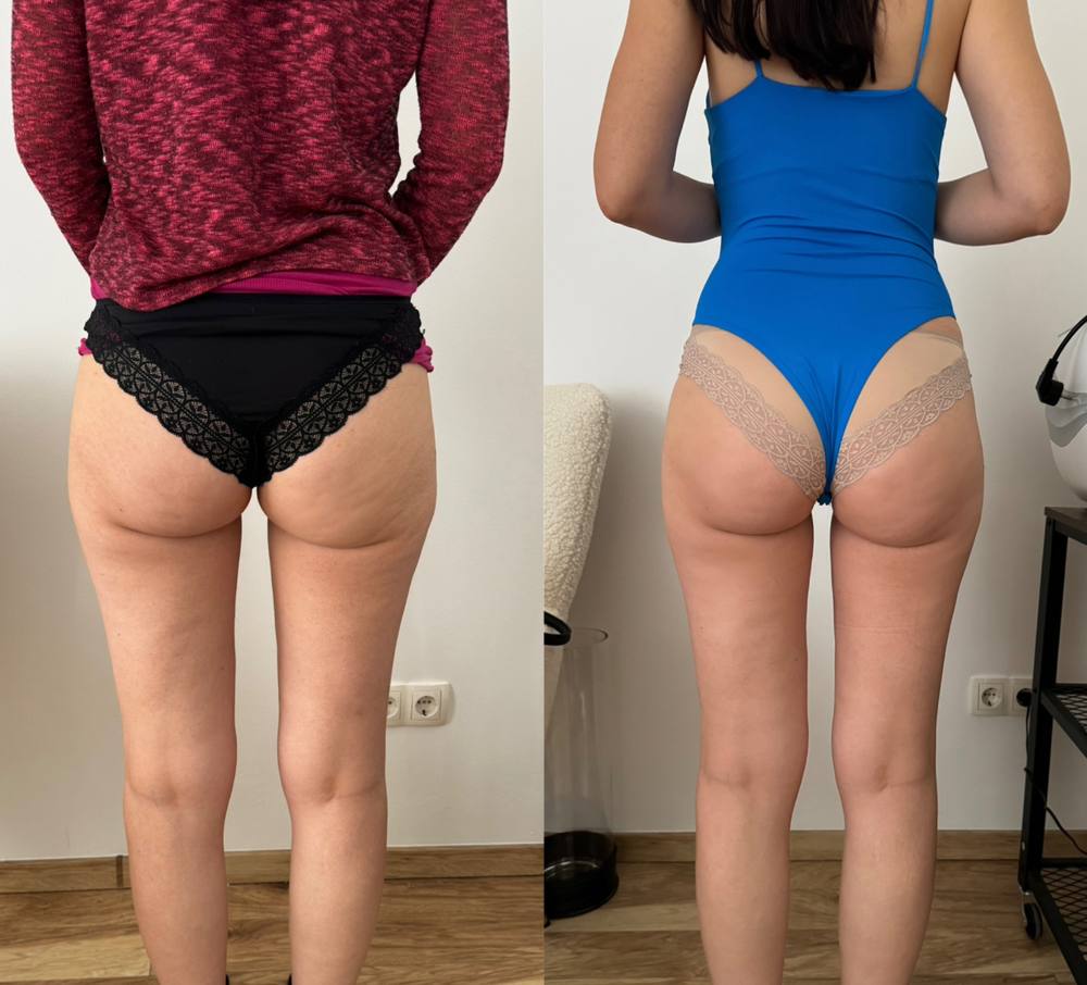 Alakformálás 2 testrész komplex csomag eredmény Budapest
