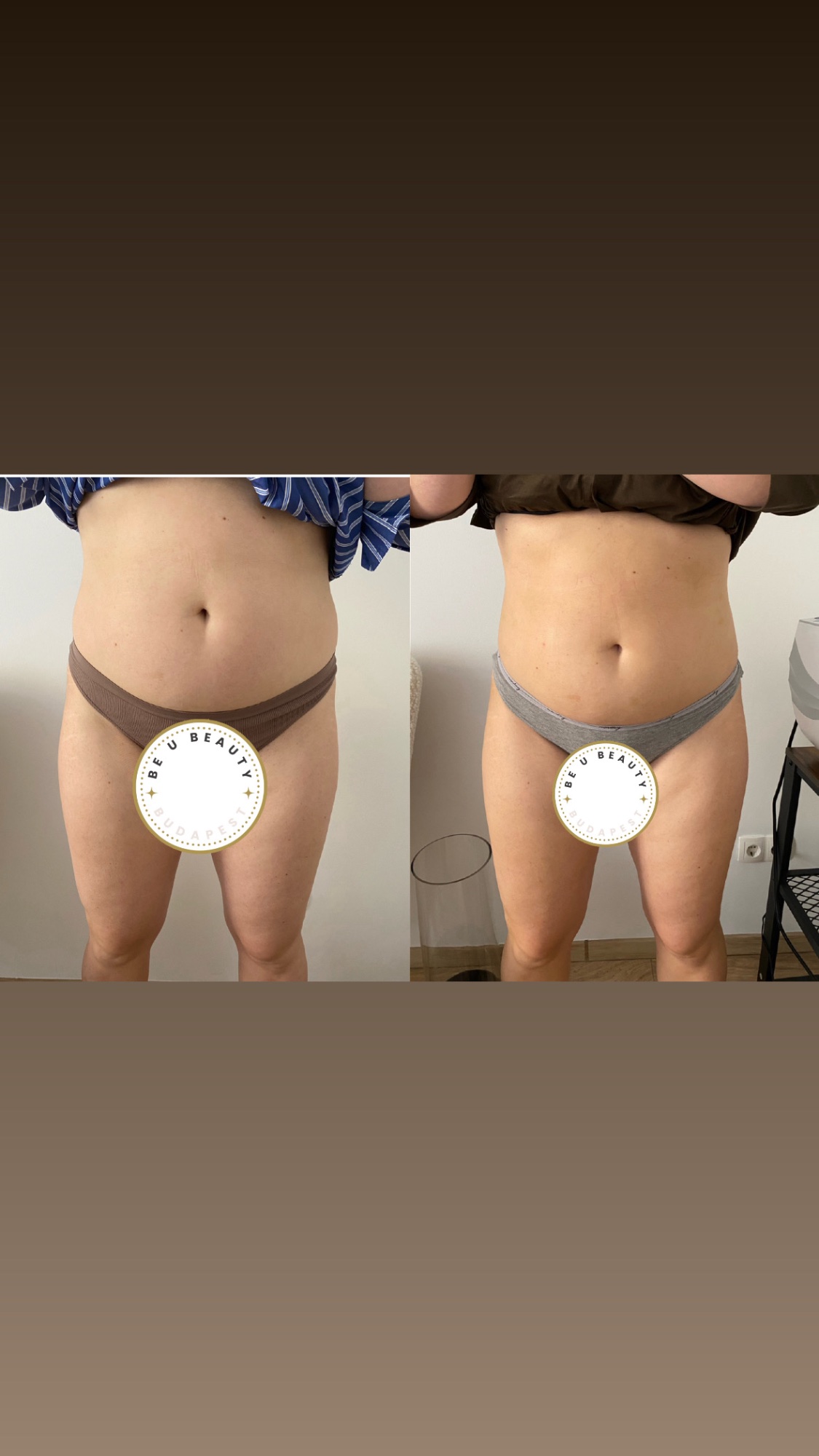 Lézeres szőrtelenítés eredmény