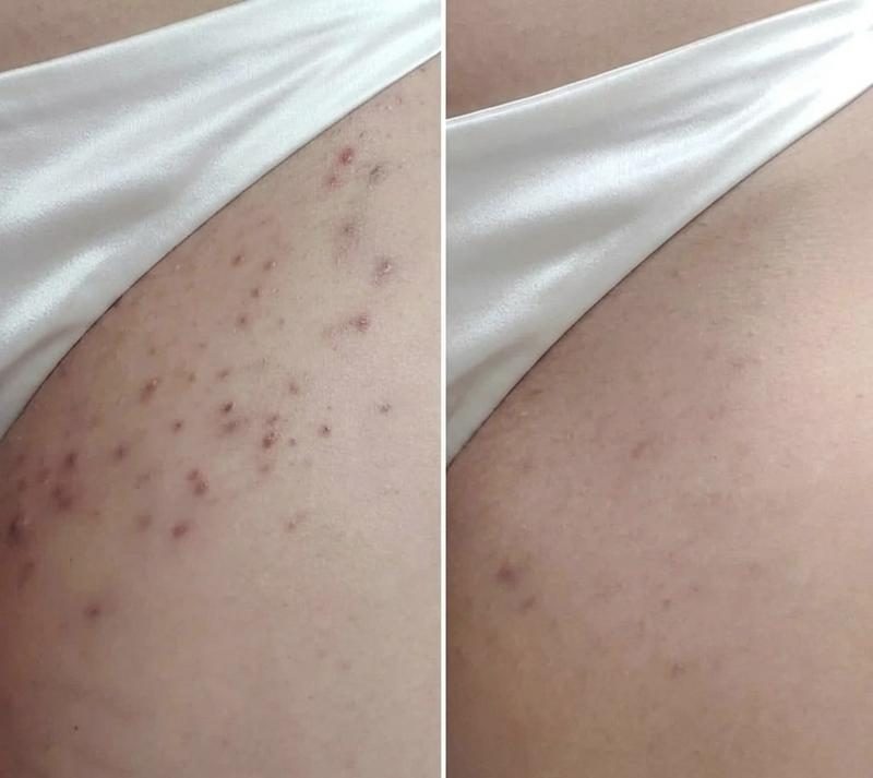 Alakformálás eredmény oldalsó profil - feszesebb fenék és combok