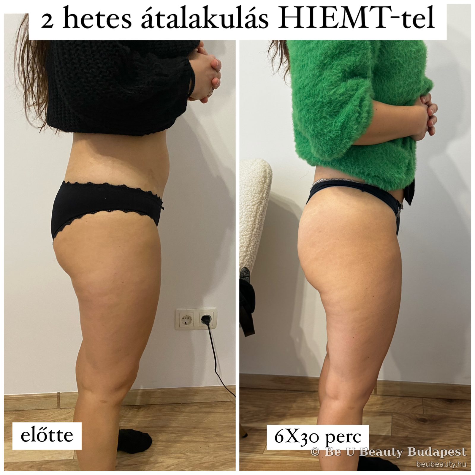 2 hetes átalakulás HIEMT-tel — vendég előtte-utána, 6×30 perc kezelés, fenék és comb oldalnézet