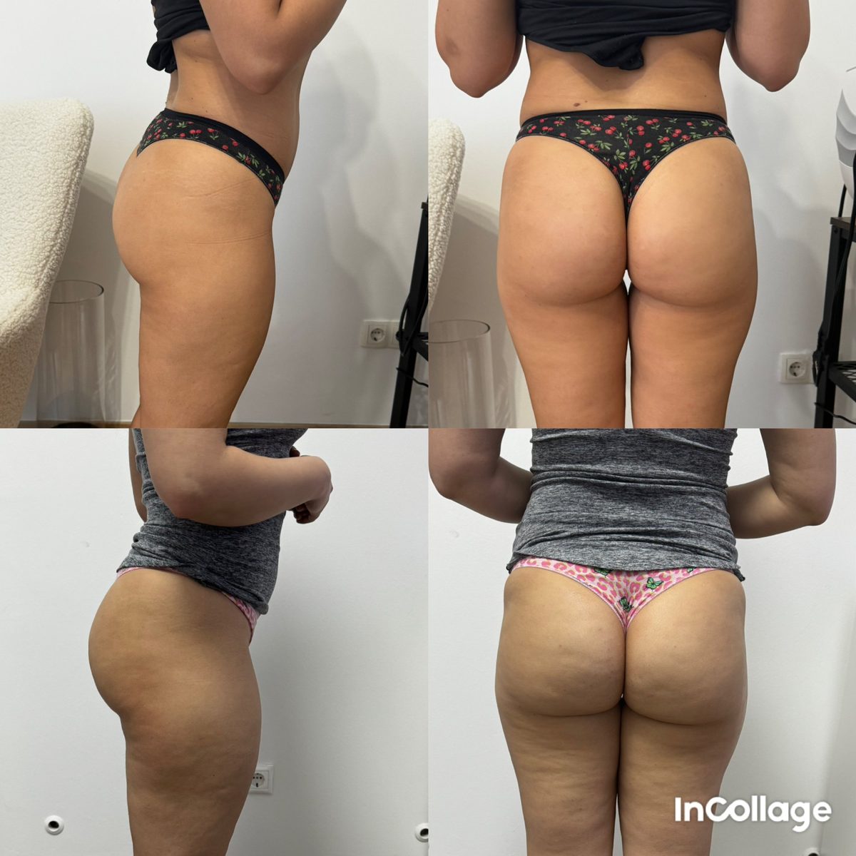 HIEMT fenék és comb