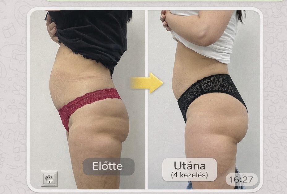 HIEMT komplex hybrid