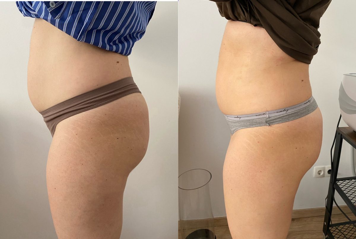 HIEMT has előtte utána