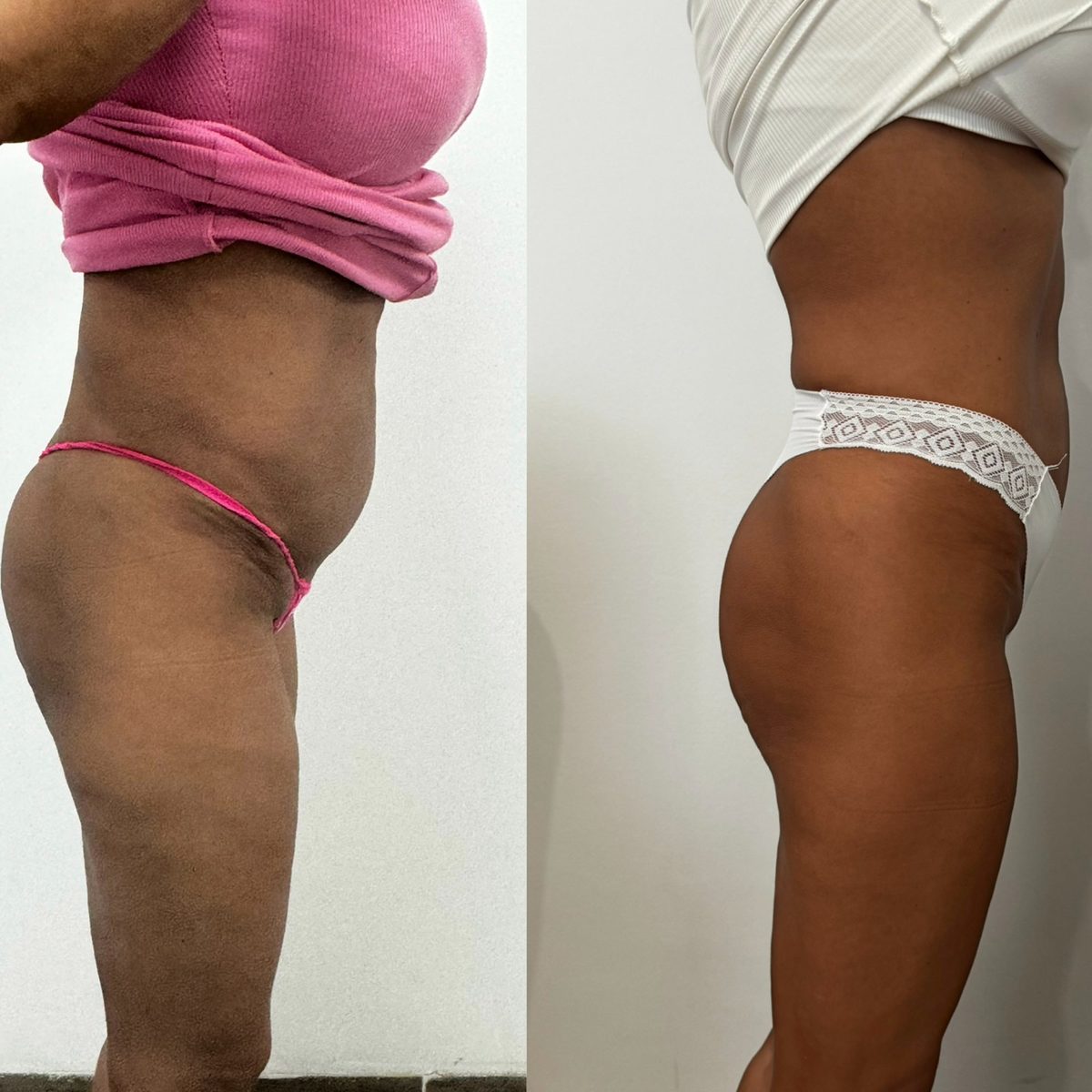 HIEMT has és fenék