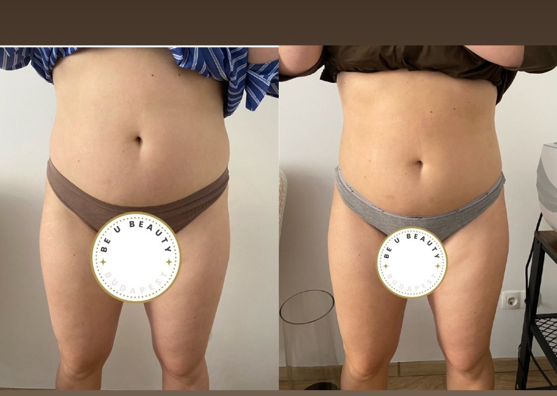 HIEMT has zsírbontás