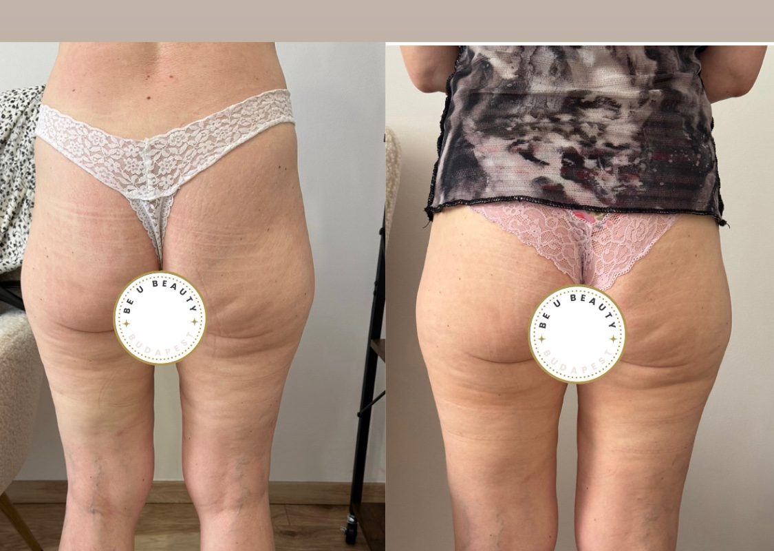 HIEMT comb narancsbőr