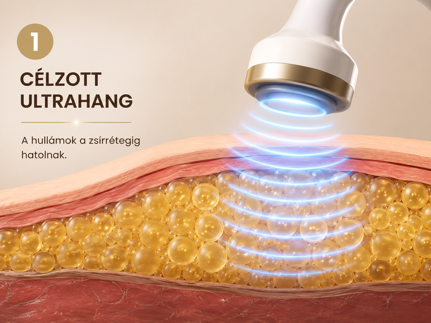 Ultrahangos kavitáció 1. lépés — célzott ultrahanghullám a zsírrétegig