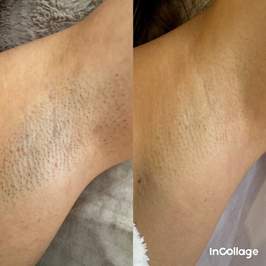 Laser hair removal result — underarms, before and after