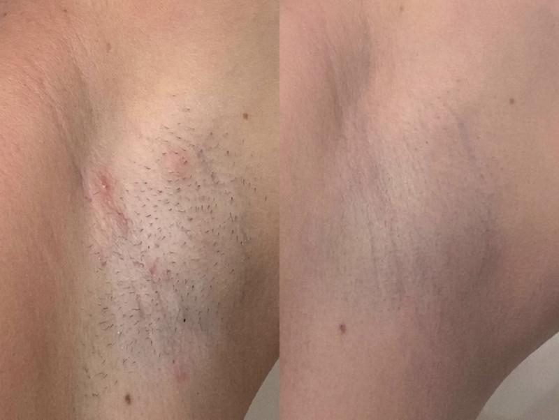Laser hair removal result — underarms, case 2