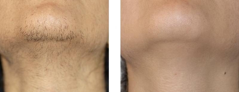 Laser hair removal result — chin, before and after