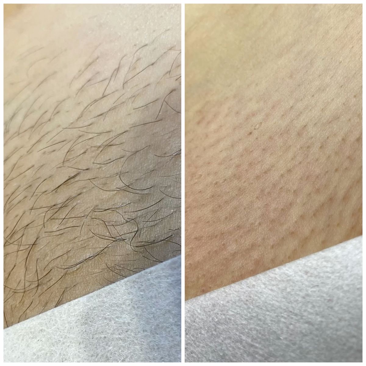 Laser hair removal result close-up, before and after