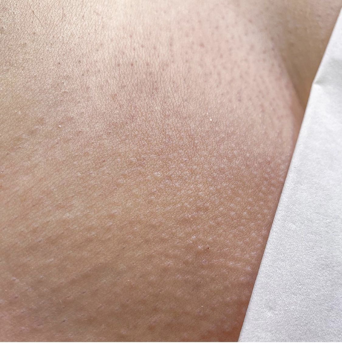 Lastingly smooth skin close-up, after treatment