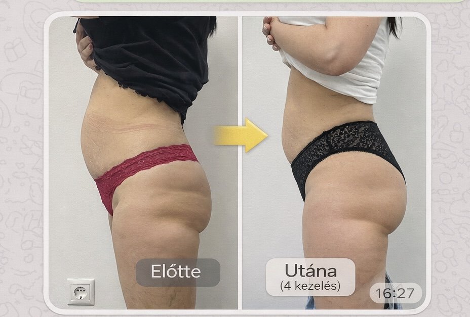Előtte utána has comb 4 kezelés